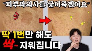 왜 레이저 10번이나 하세요? 딱 1번이면 돼요 | 잡티, 흑자, 주근깨의 모든 것!!