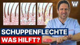 Schuppenflechte: Rote Haut, starker Juckreiz und Schuppenbildung! Ist Psoriasis heilbar? Was hilft?