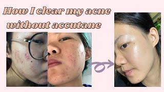 How I got rid of my Cystic Acne & pimples with Eighteen Vitaskin Supplement (without Accutane)