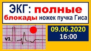 Важнейшие ЭКГ-синдромы: полные блокады ножек пучка Гиса