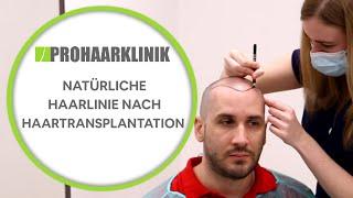 Natürliche Haarlinie nach Haartransplantation - PROHAARKLINIK