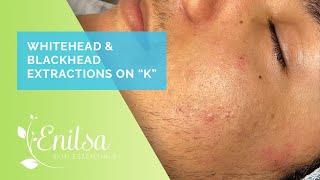 Enilsa is back! Whitehead & Blackhead Extractions on "K" - Part 1