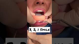 In 3s zum SMILE! Smile Test by Dr. Boeddinghaus #flowableinjection #veneers #dentist