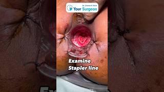 In 1 minute - Stapler Hemorrhoidectomy - In Simple English - Piles Surgery - MIPH operation I Mumbai