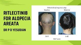 Ritlecitinib for alopecia areata