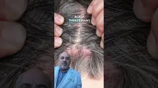 Scalp Flaking