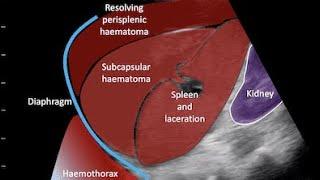 Splenic Hematoma