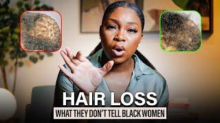 The Truth About Hair Loss in Black Women - What You Need to Know Today