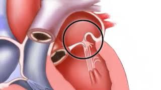 Mitral valve regurgitation