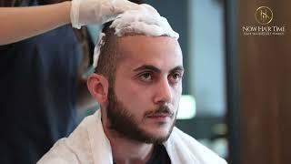 How To Remove The Scabs After Hair Transplant 2023 - Now Hair Time