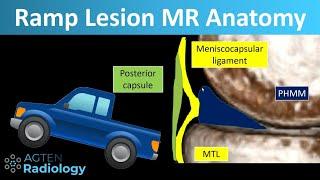 Ramp Lesions on Knee MRI (Anatomy)