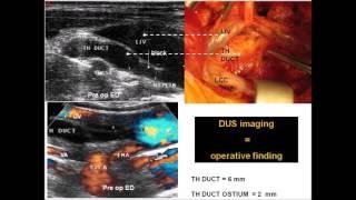 Thoracic duct end obstruction - By Claude Franceschi