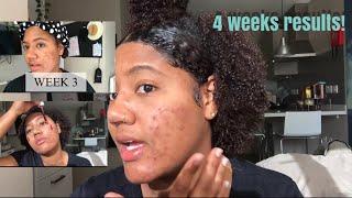 The Ordinary Peeling Solution Before & After | 4 weeks