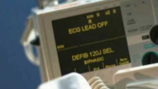 Atrial Fibrillation Ablation (AFA)
