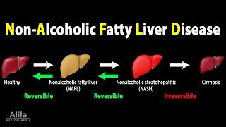 Nonalcoholic Fatty Liver Disease (NAFLD), Animation