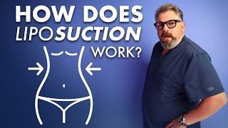 The Real Deal On How FAT Is Removed In Liposuction