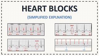 Heart Blocks ECG | AV Blocks ECG | Simplified Explanation with Examples