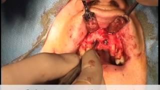 Implant with fenestration