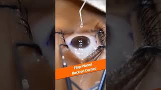 Lasik for spectacle removal#shortsvideo #viralvideo #education #optometry #eye #ophthalmology#shorts