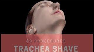 Adam´s Apple Reduction / Trachea Shave feminization in 3-D | FACIALTEAM