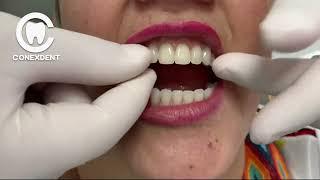 This dental prosthesis does not fall out of your mouth    #protesisdental