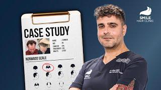 3700 Grafts Hair Transplant | 12-Month Results with Dr. Bilgin | Case Study