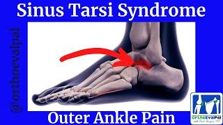 Sinus Tarsi Syndrome (Outer Ankle Pain)