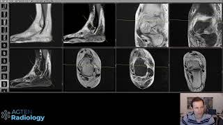 Live MRI interpretation - Ankle