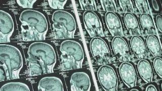 Understanding aphasia and its recovery process