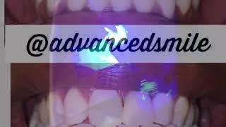 Welcome to Advanced Smile Lab Cosmetic Teeth Whitening