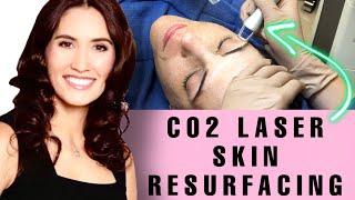 Laser Skin Resurfacing CO2RE  - Acne Scars | Wrinkles | Skin Anti Aging - Perich Aesthetics Tampa Fl