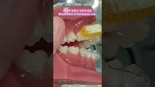 #교정칫솔사용법, How to use braces brush, #교정전문의 #치아교정
