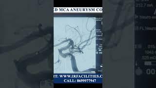 #SHORTS #BILOBED MCA ANEURYSM COILING #IRFACILITIES