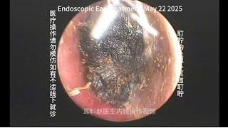 Cerumen hooks to clear cerumen plugs in the ear canal 20250522