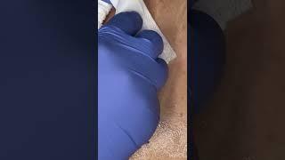 Black head extraction on client lower back
