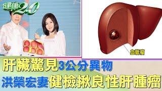 肝臟驚見3公分異物 洪榮宏妻健檢揪良性肝腫瘤 健康2.0