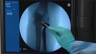 Radial Head Fracture Replacement using Long Stem Acumed ARH 2 System with Marc Richard, MD
