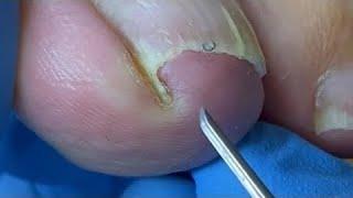 Pulling Out Huge Nails And Crazily Filling The Nail Grooves【Pedicure Master Lin Jun】