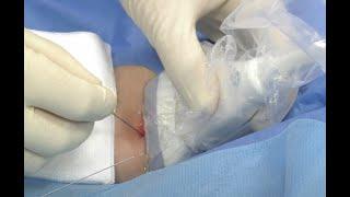 Brachial artery line insertion