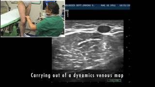 Perthes maneuver  predictive  of CHIVA result