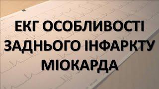 ІНФАРКТ МІОКАРДА ЗАДНЬОЇ СТІНКИ: ЕКГ - ОСОБЛИВОСТІ