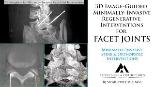 Facet Joint Arthritis of the Spine: Minimally-Invasive Regenerative Injections with 3D Guidance