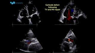 Spring Ultrasound Knowledge Booster #4: Don’t miss this surgical complication