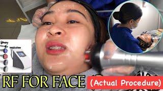 RF FOR FACE (RADIOFREQUENCY - ACTUAL PROCEDURE!)