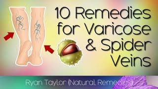 10 Natural Treatments for Varicose Veins & Spider Veins