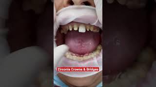 Zirconia Crowns and Bridges #shorts