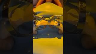 The cementation process for two porcelain veneers #veneers #veneers #cosmeticdentistry