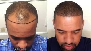 African American Hair Transplant - Before and After one year