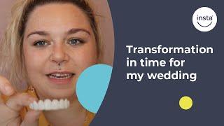 Wedding Smile Transformation | Clip On Veneers | Instasmile Review