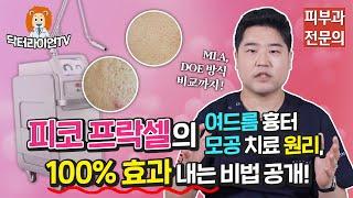 [여드름 흉터 정복 6탄] 피코 프락셀의 여드름 흉터·모공 치료 원리, 100% 효과 내는 비법 공개!